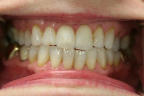 Teeth before whitening treatment.